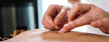 Reasons Why Acupuncture is Better Than Traditional Medicine